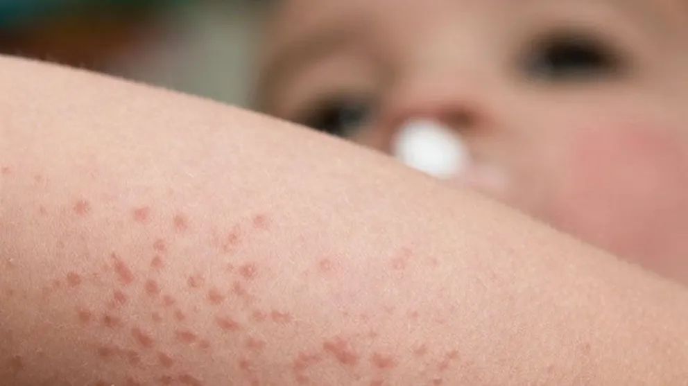 Dermatitis Atópica, un trastorno cutáneo que padecen entre un 15 y 30% de los niños