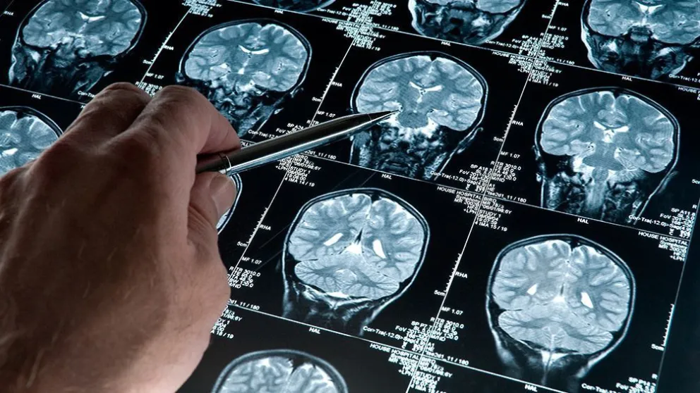Día Mundial del Alzheimer: ¿Cómo se concientiza en Bariloche sobre esta enfermedad?