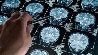 Día Mundial del Alzheimer: ¿Cómo se concientiza en Bariloche sobre esta enfermedad?